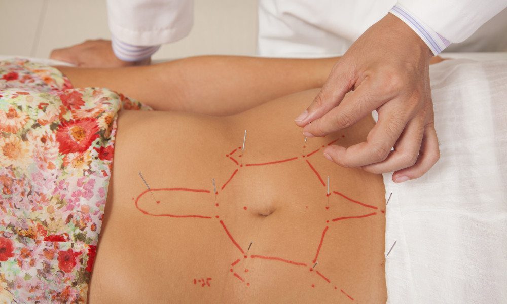 This Is What Happens to Your Body When You Try Acupuncture