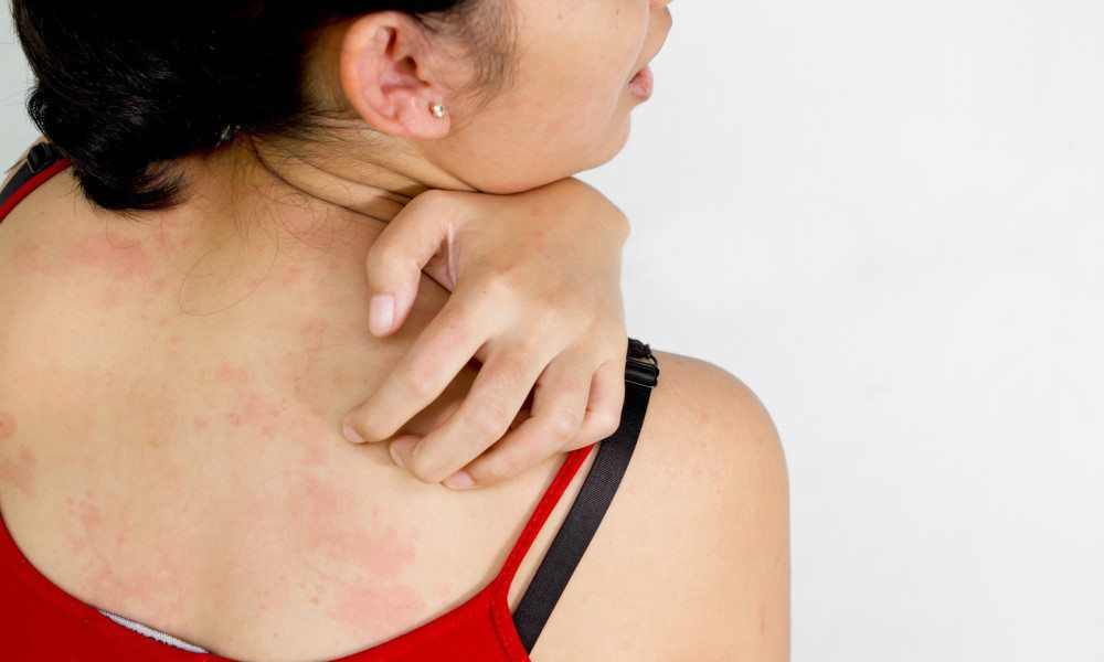 10 Natural Home Remedies For Heat Rash + Prevention Tips
