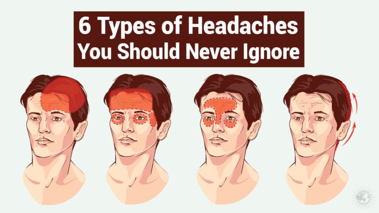 types of headaches
