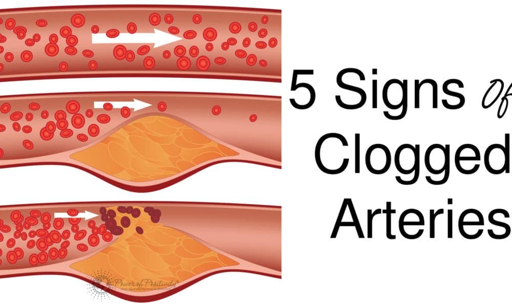 5 Signs Of Clogged Arteries