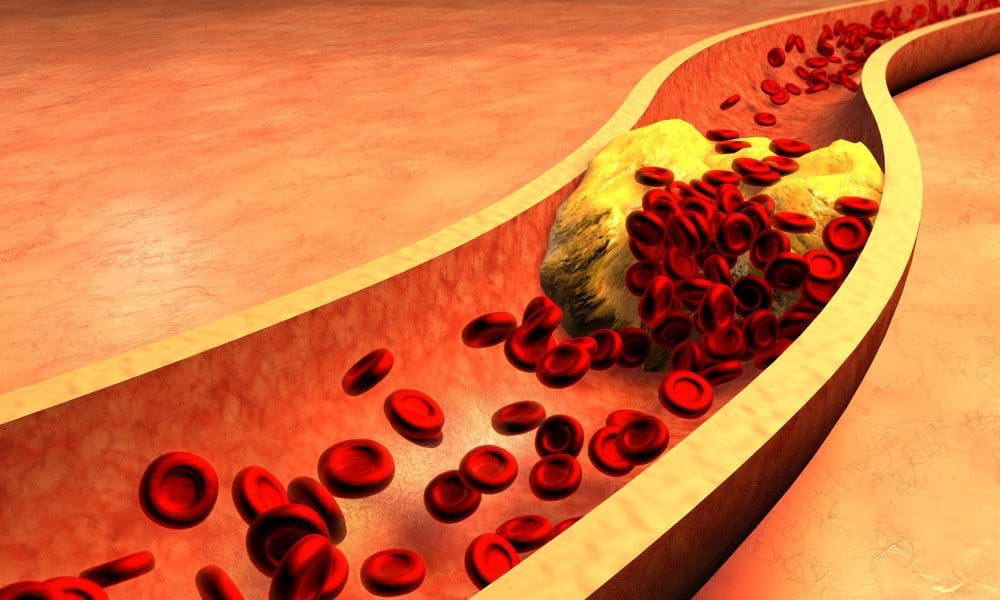 This New Technology Can Completely Clean Arteries