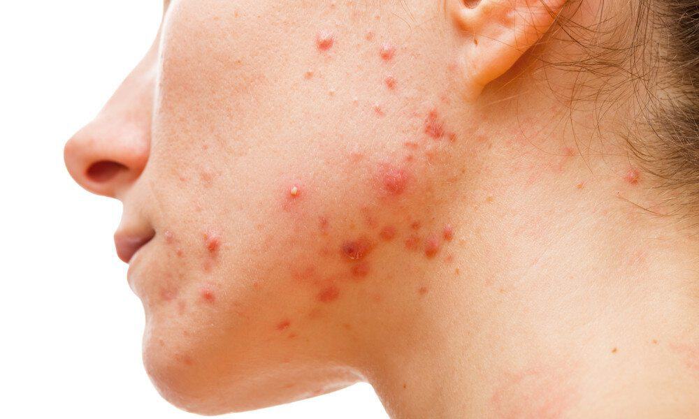 Eliminating This ONE Ingredient Can Completely Clear Your Skin
