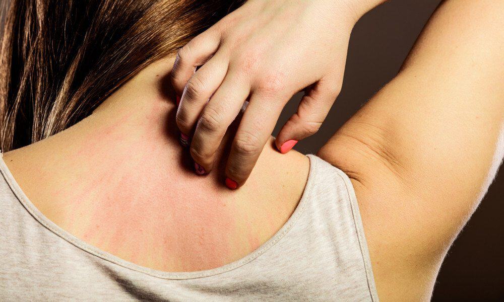 Covered In Heat Rash? Try These Simple & Effective Home Remedies