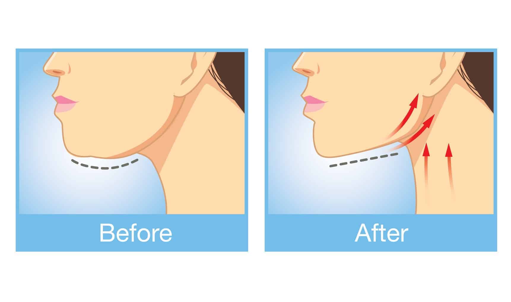 The 5 Most Effective Methods To Get Rid of A Double Chin