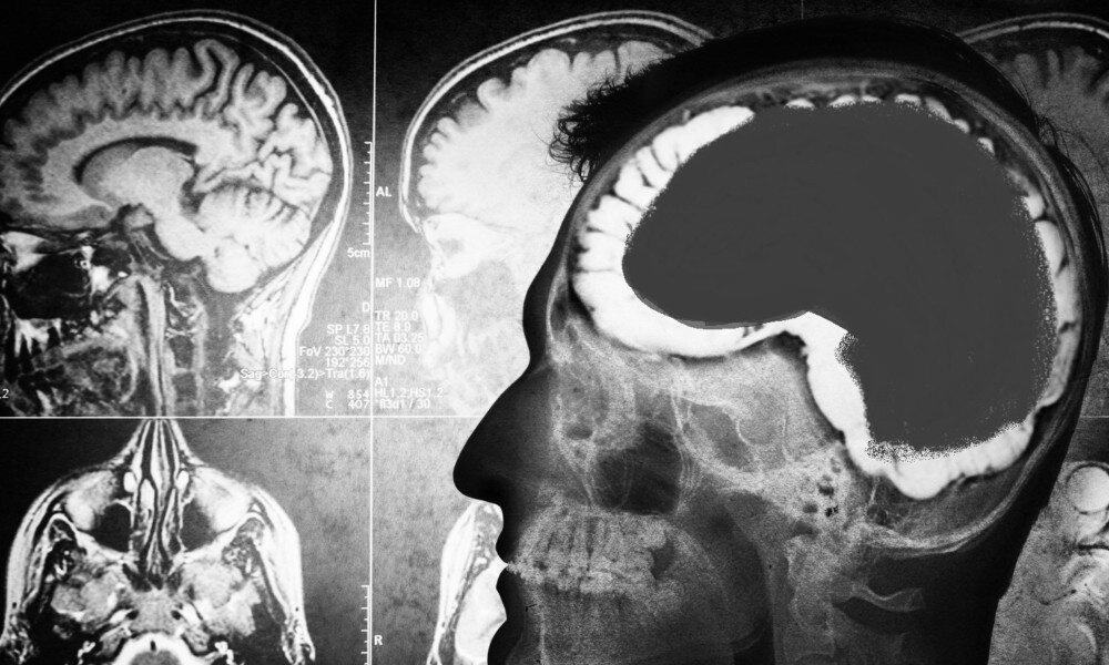Man Missing 90% Of His Brain Challenges Everything We Thought We Knew About Consciousness