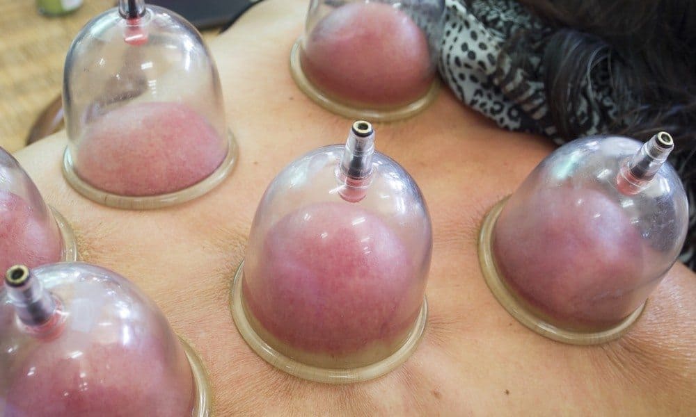 Science Explains 5 Things That Happen To Your Body When You Try Cupping