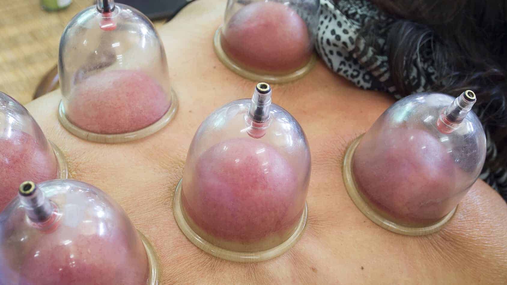 cupping