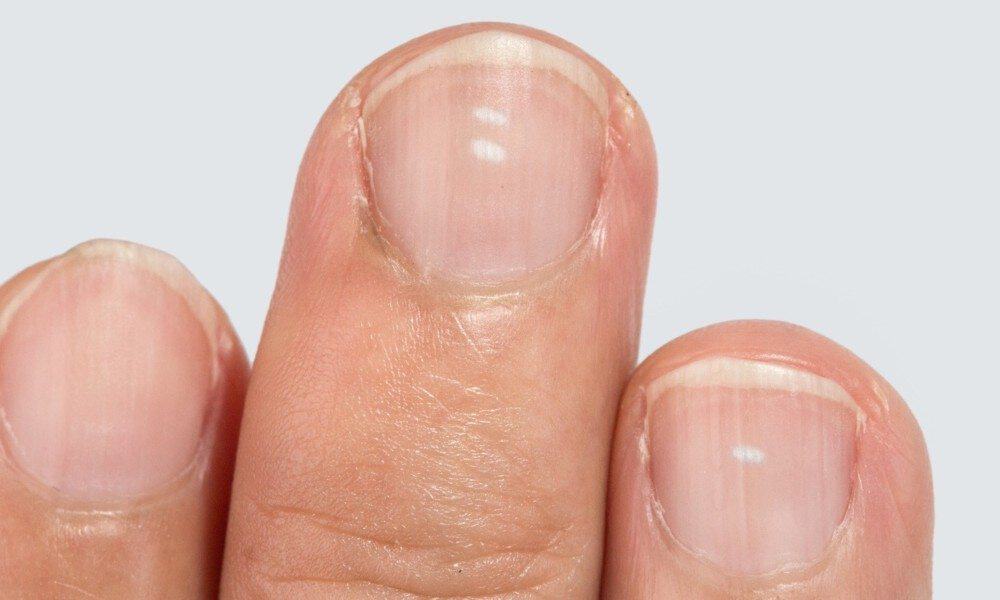 8 Health Warnings to Never Ignore From Your Fingernails