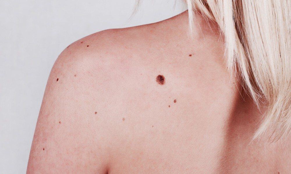 skin health moles