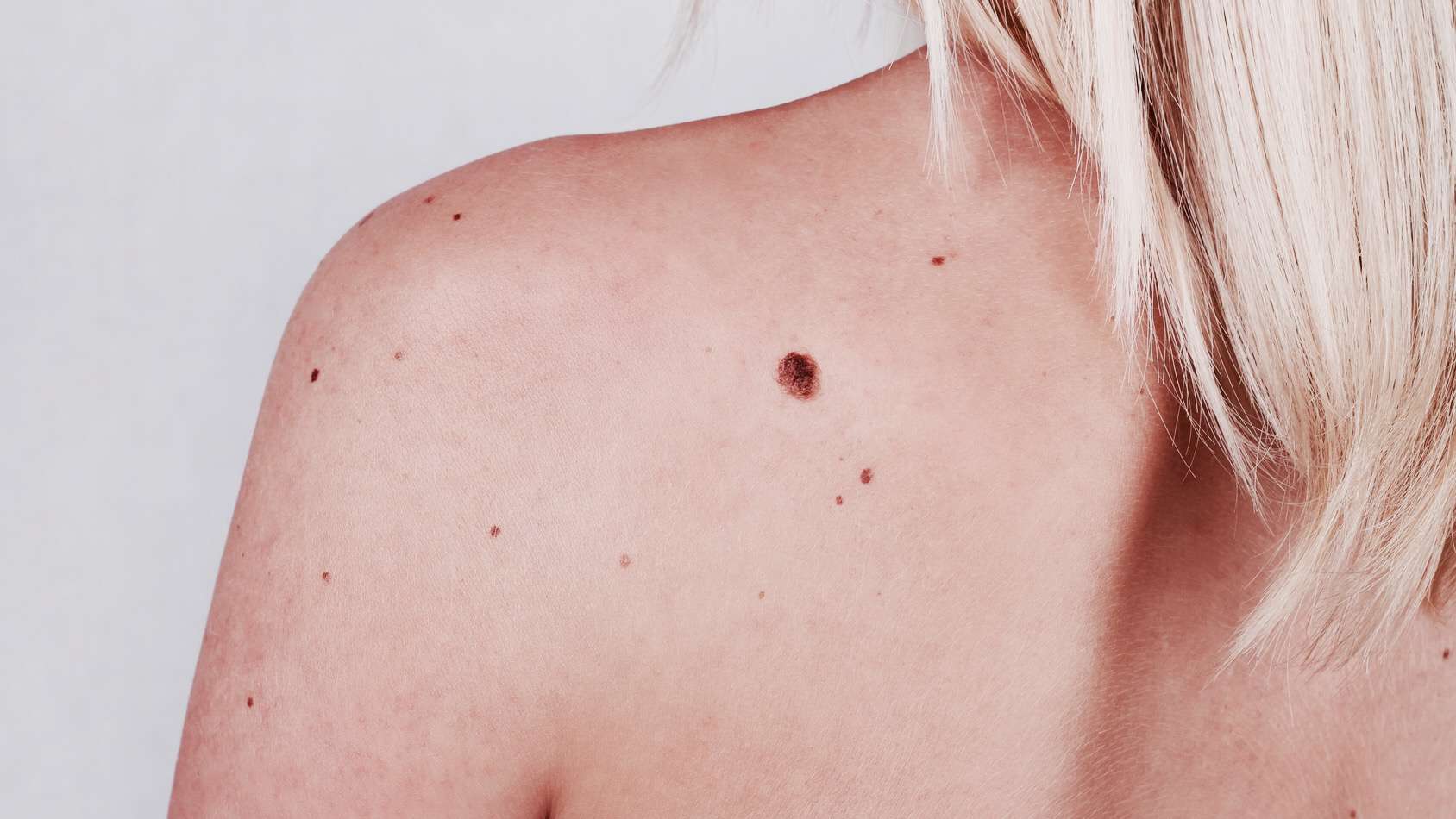 skin health moles