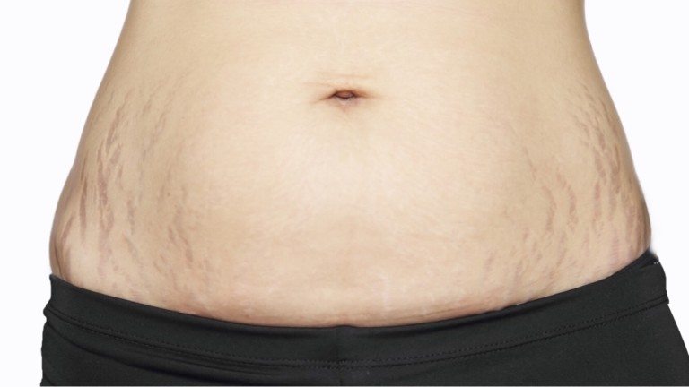 stretch marks