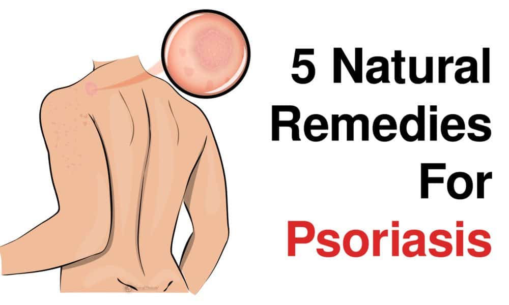 5 Natural Remedies For Psoriasis