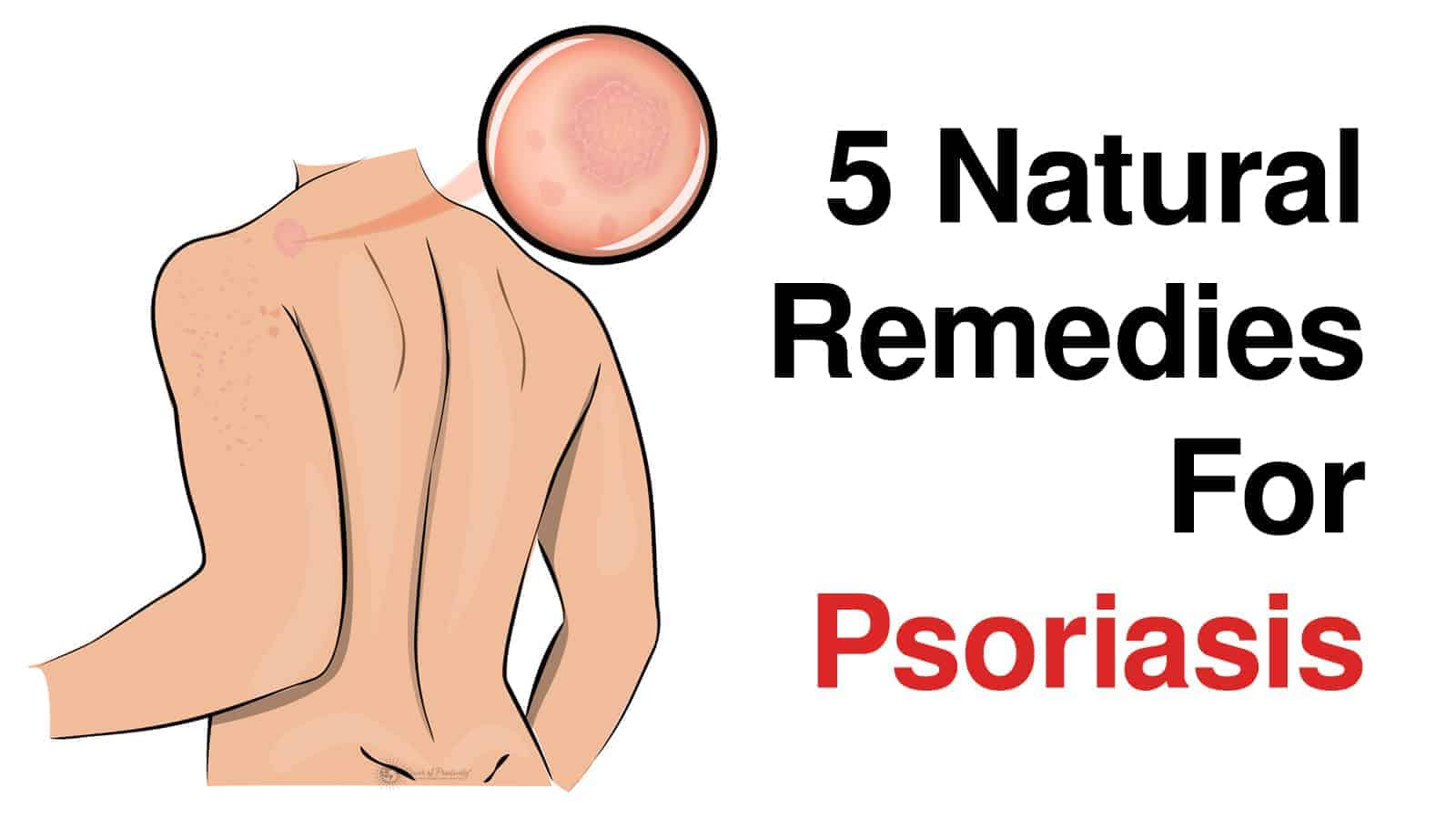 psoriasis