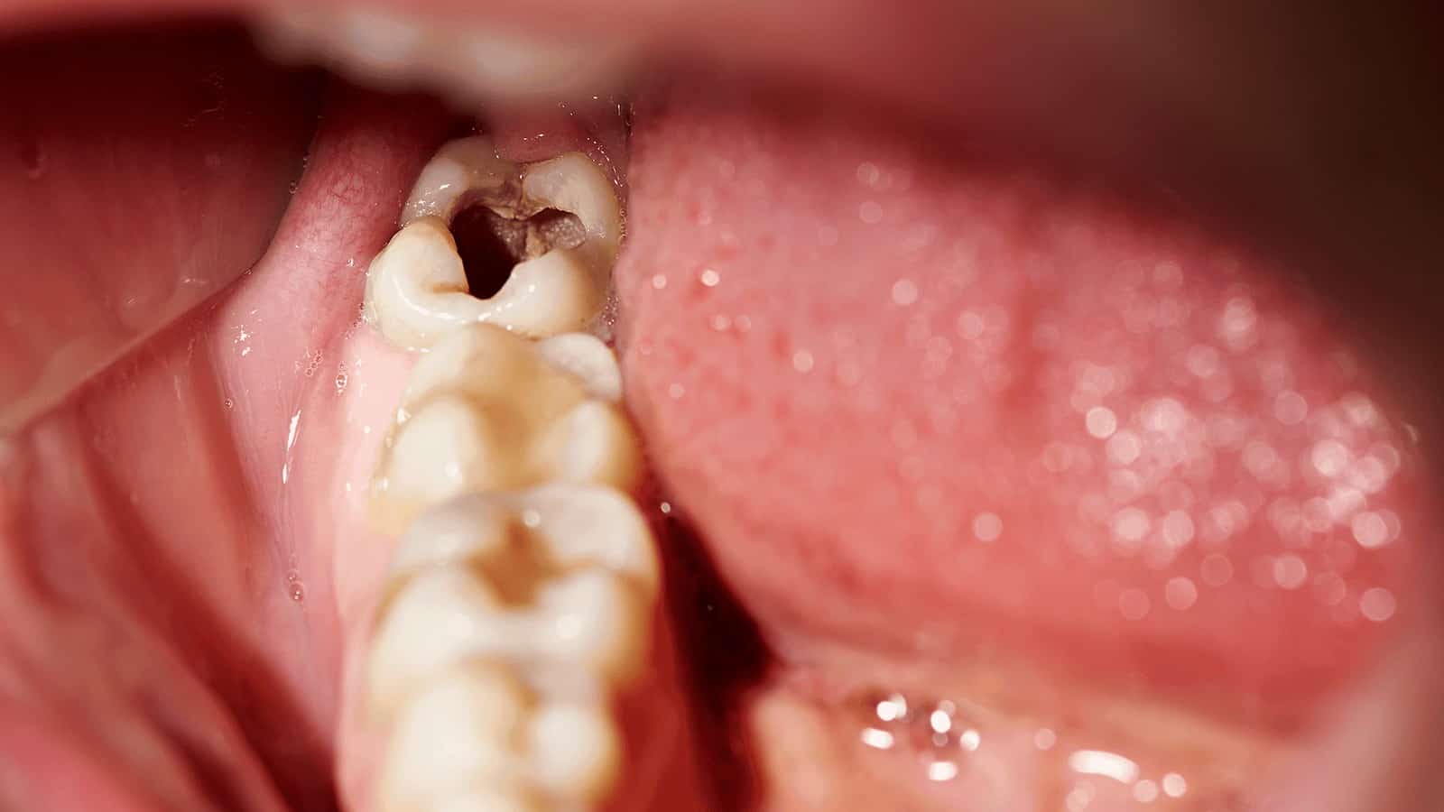 9 Natural Ways To Prevent Cavities and Relieve Tooth Pain
