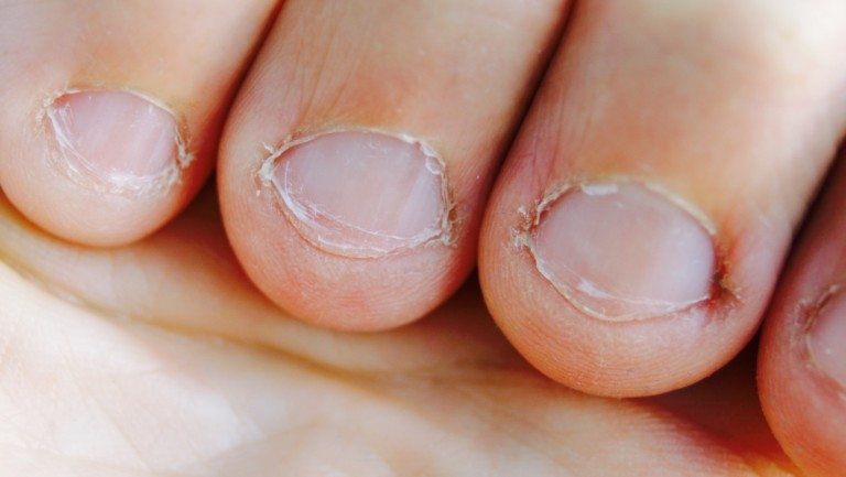 bite nails