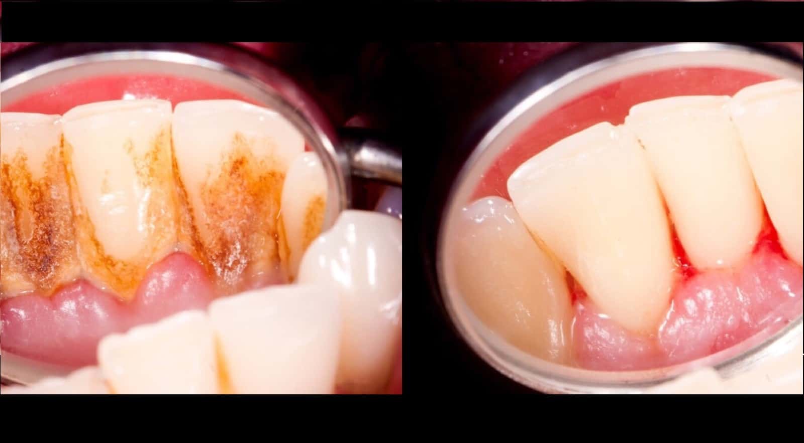 4 Mixtures That Completely Remove Plaque From Your Teeth