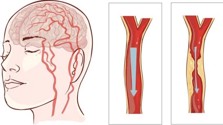 avoid stroke