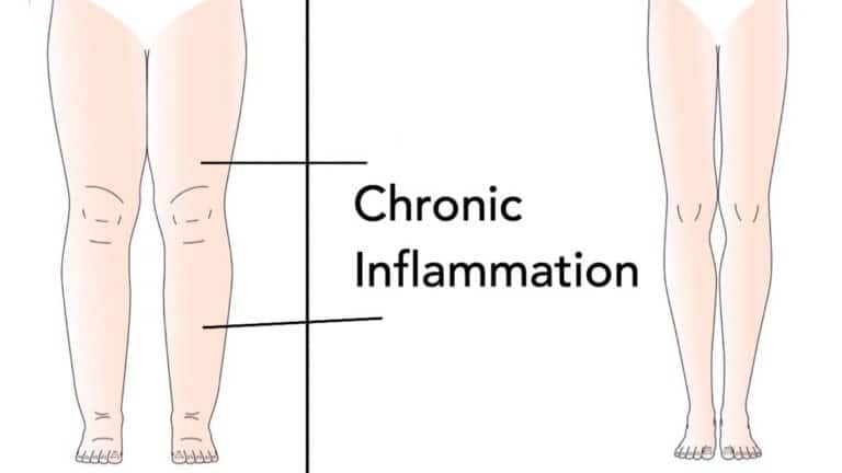 inflammation