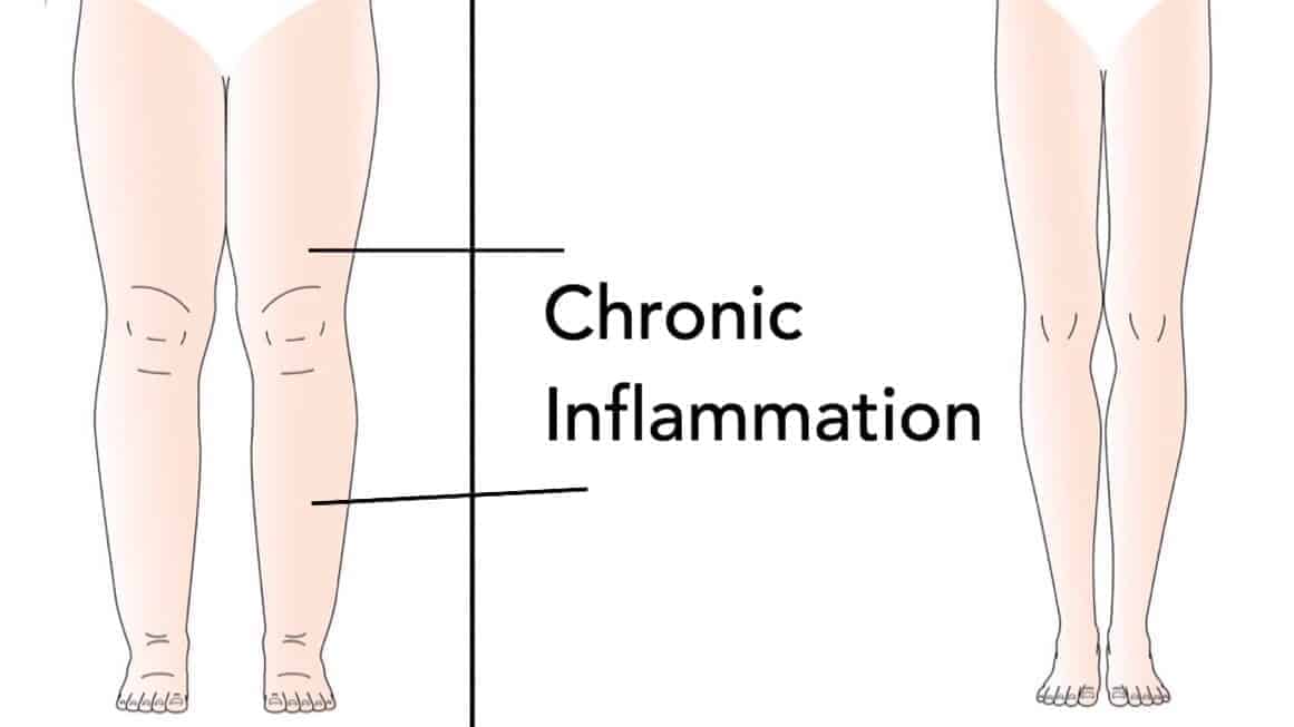 5 Reasons Your Body Gets Inflammation (And How to Avoid It)
