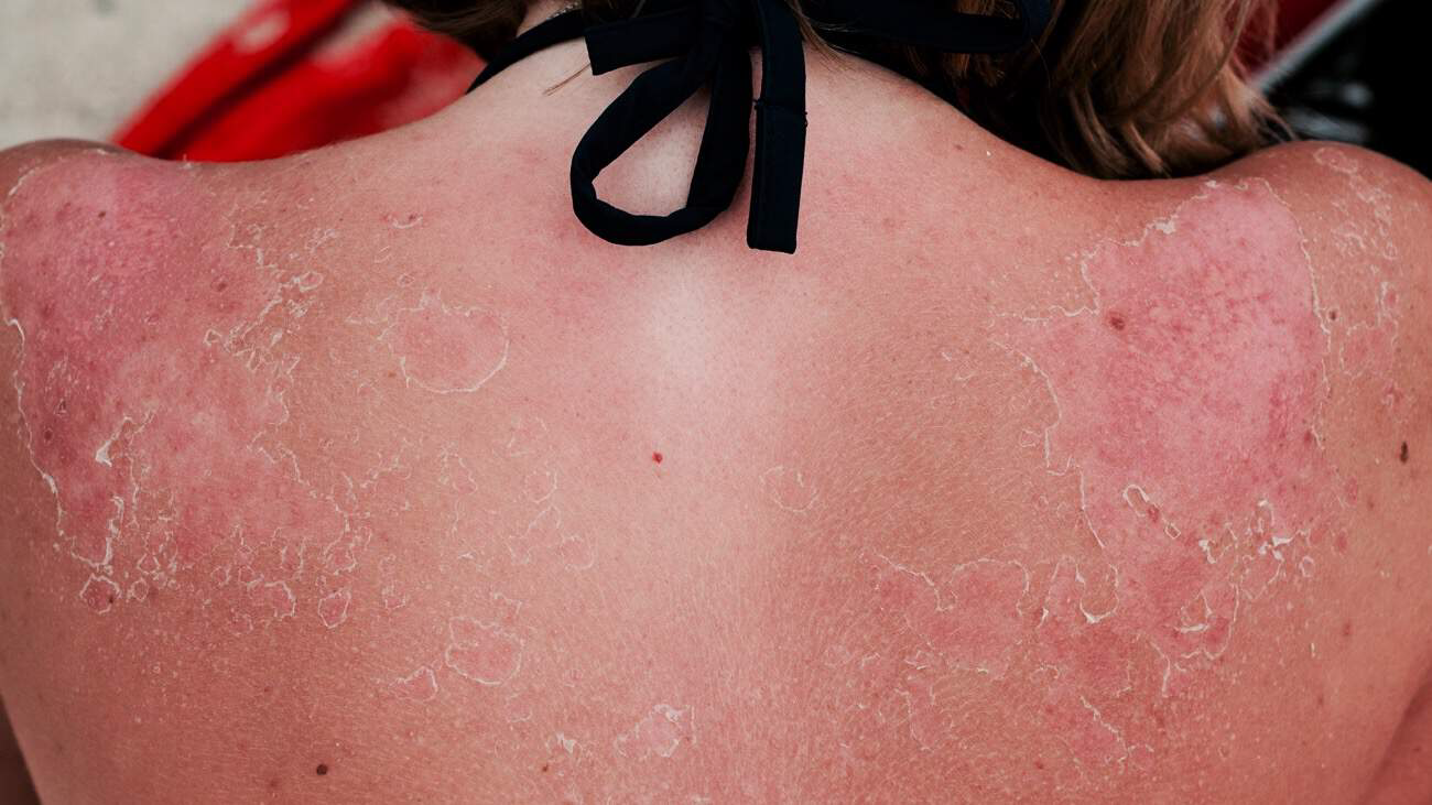 5 Signs You Have Sun Poisoning