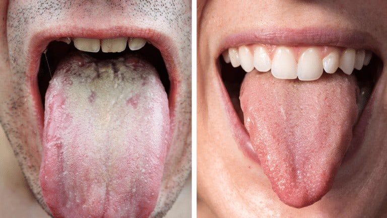 tongue health