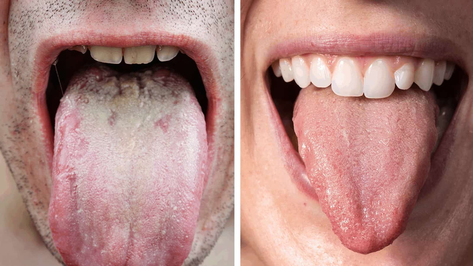 Researchers Explain What The Color of Your Tongue Says About Your Health