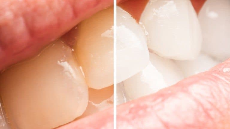 teeth whitening