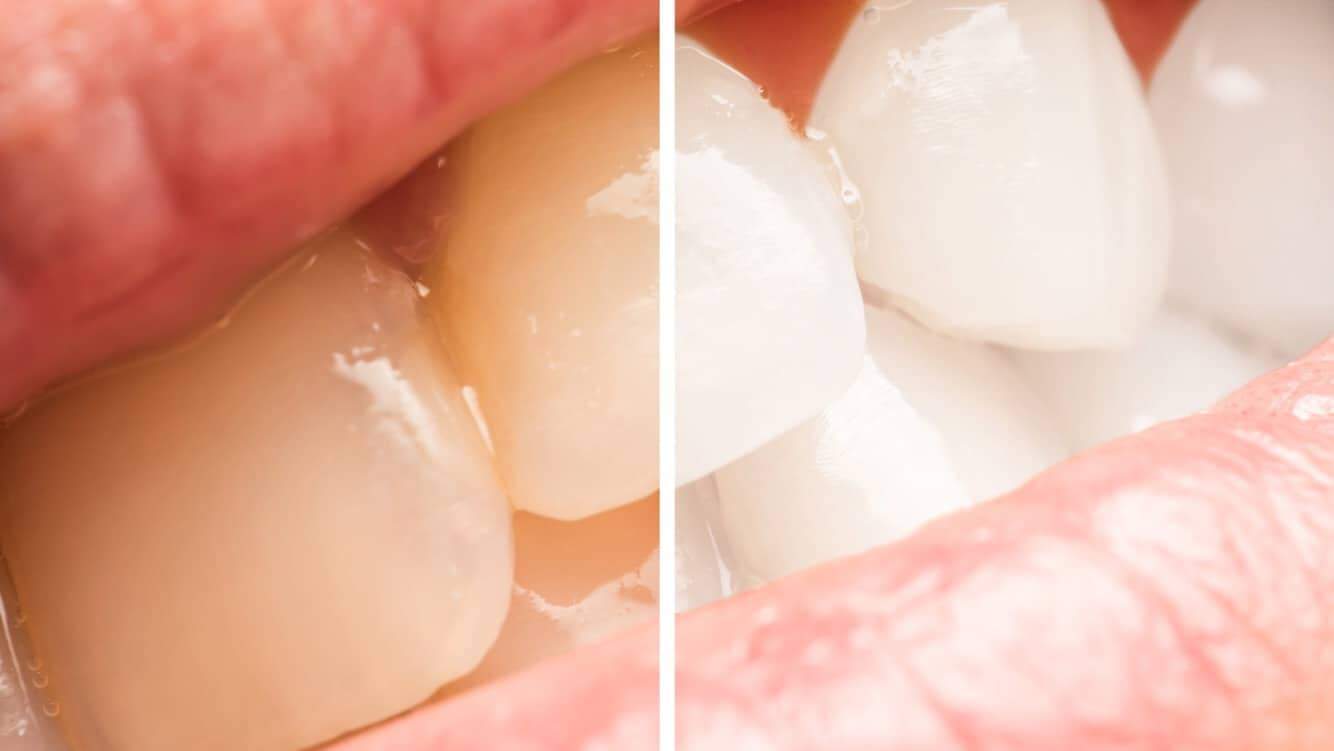 5 Easy Ways To Whiten Yellow Teeth Naturally