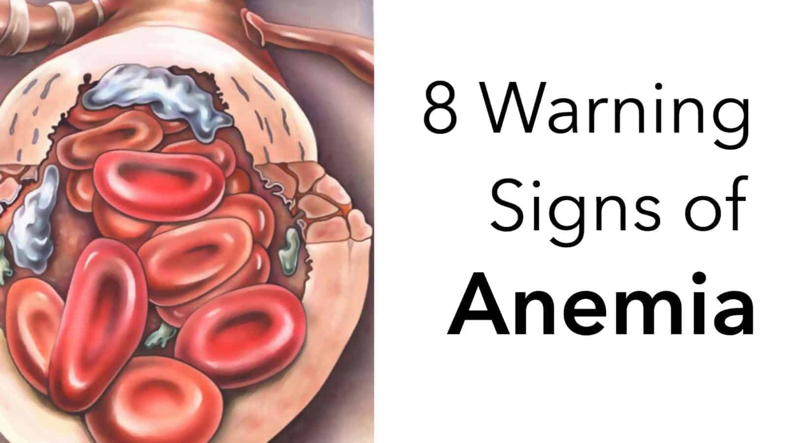 8 Warning Signs of Anemia