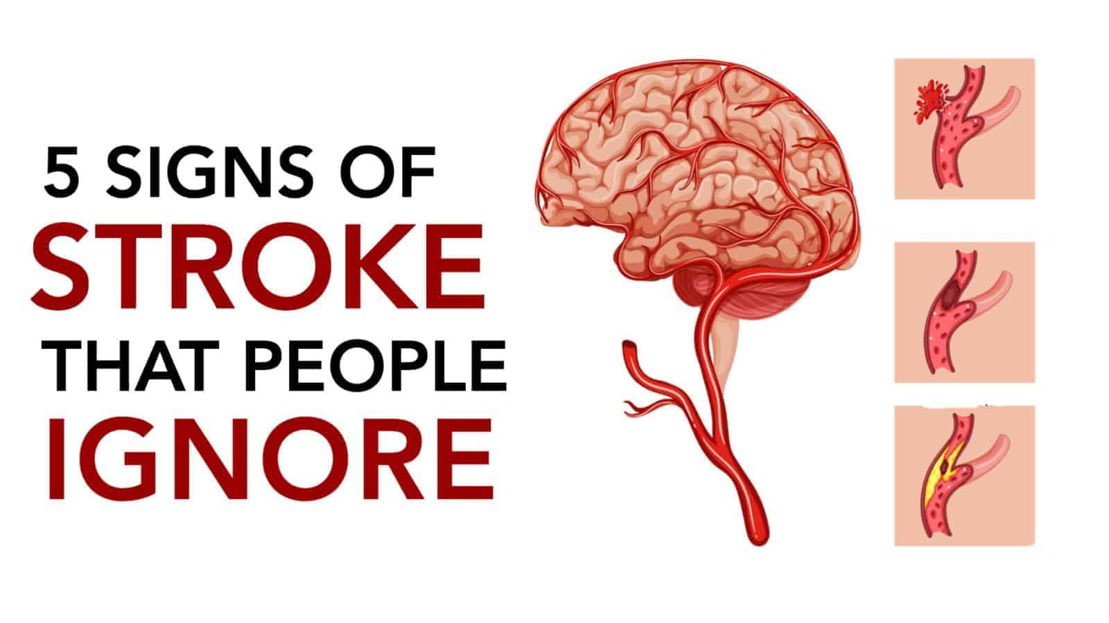 5 Signs of Stroke That People Ignore