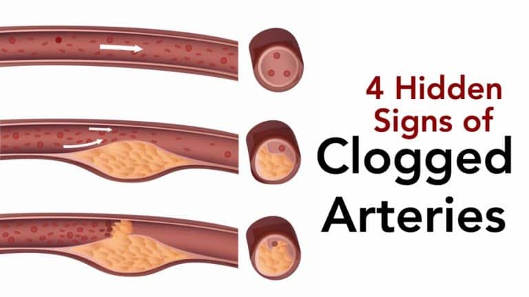 clogged arteries