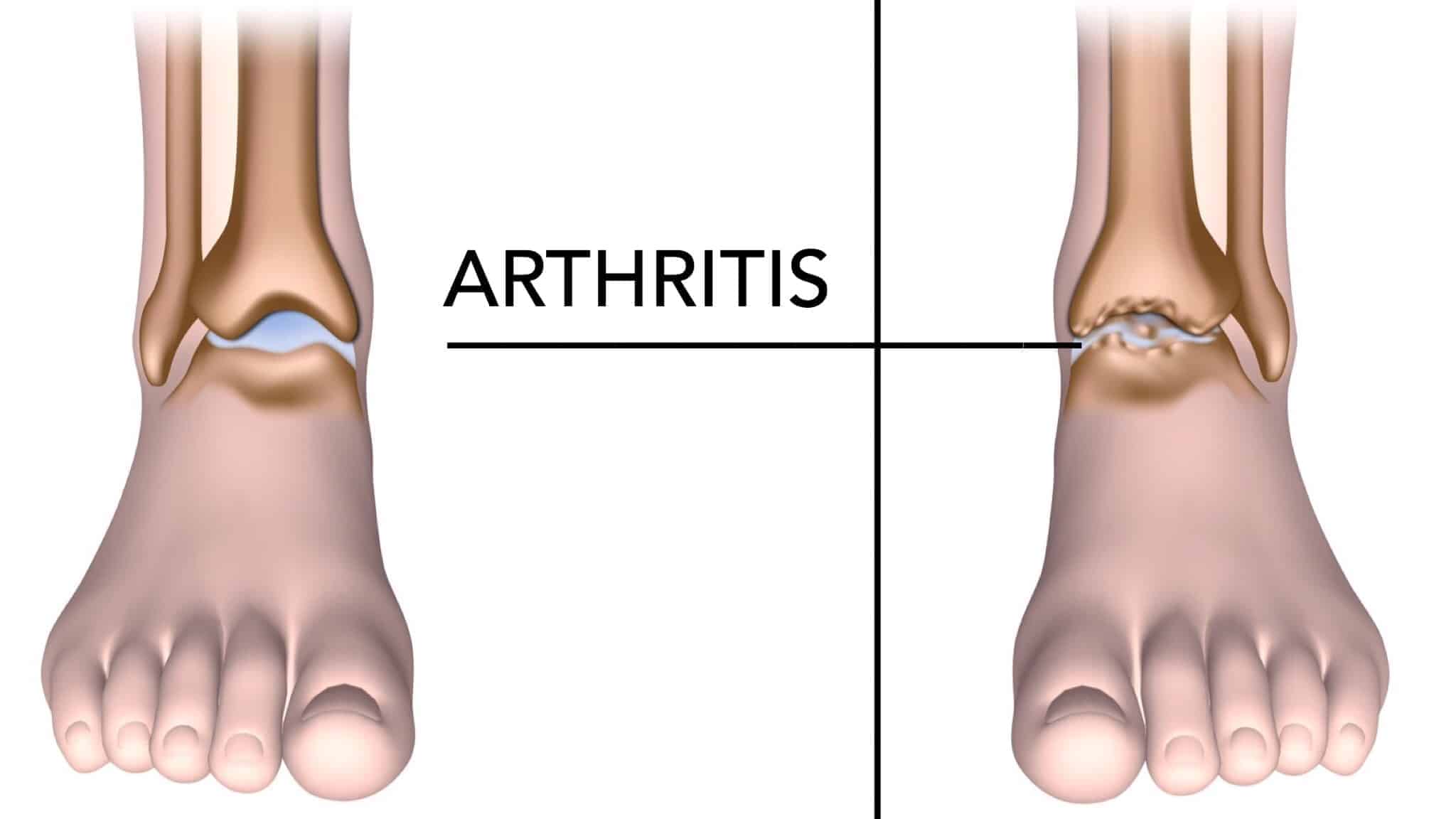 15 Foods That Help Reduce Arthritis Pain