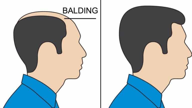 balding