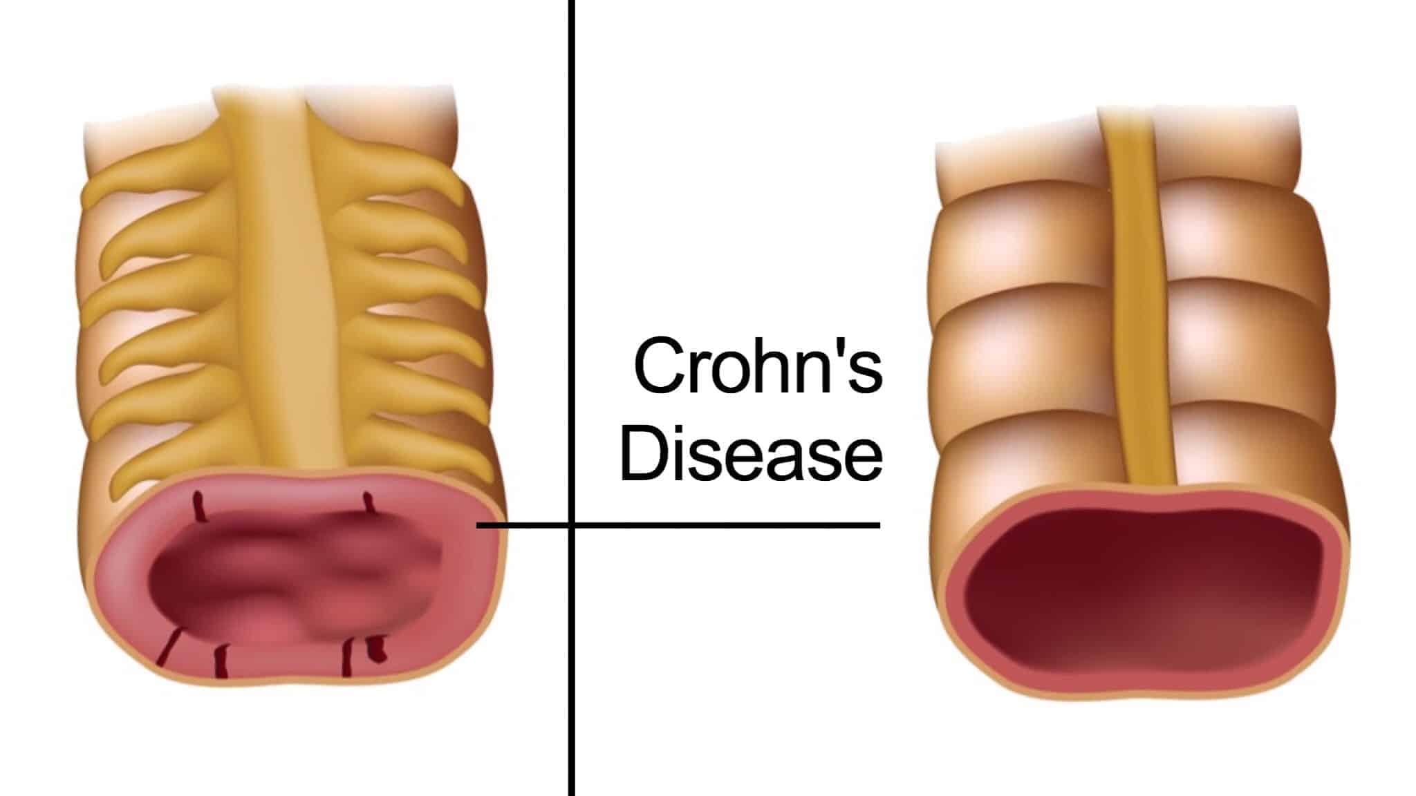 Crohn’s Disease: Symptoms, Causes, Diagnosis, and Treatment