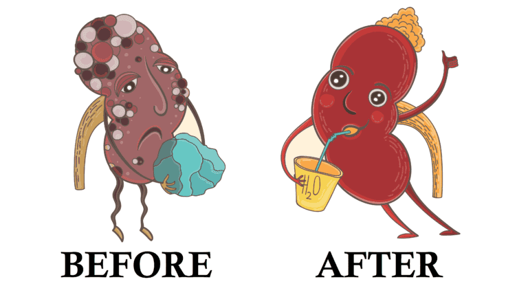 kidney stones