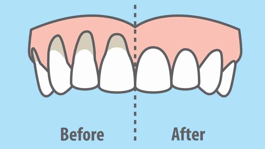 receding gums