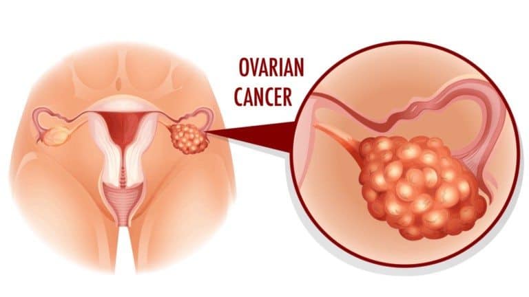 ovarian cancer
