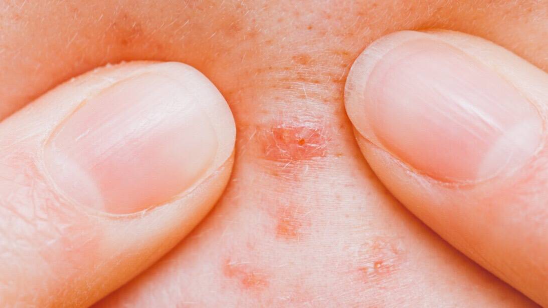 Researchers Explain What Getting Pimples Says About Your Health