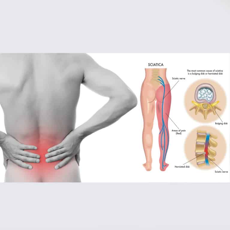 sciatica stretches