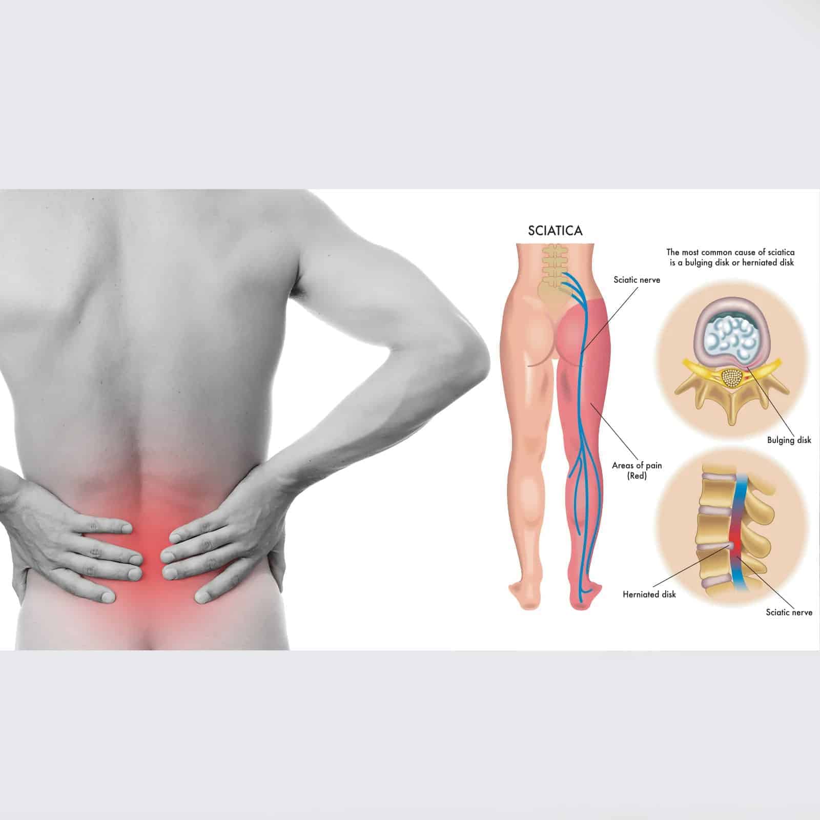 8 Sciatica Stretches That Prevent and Relieve Hip and Lower Back Pain