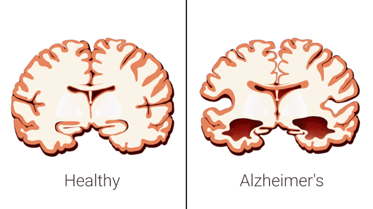 alzheimer's