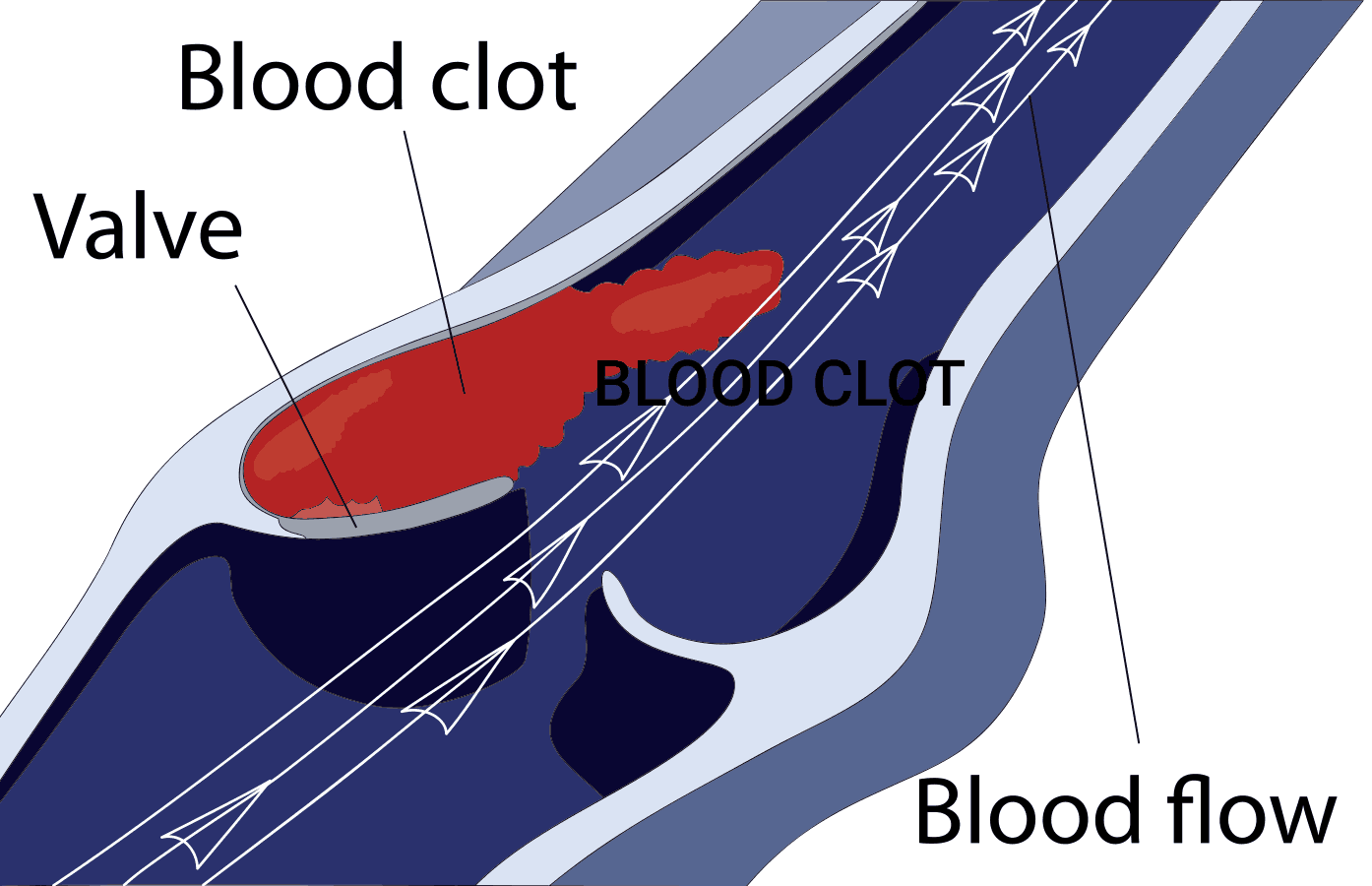 blood clot