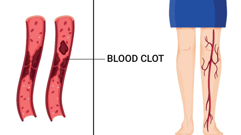 blood clot