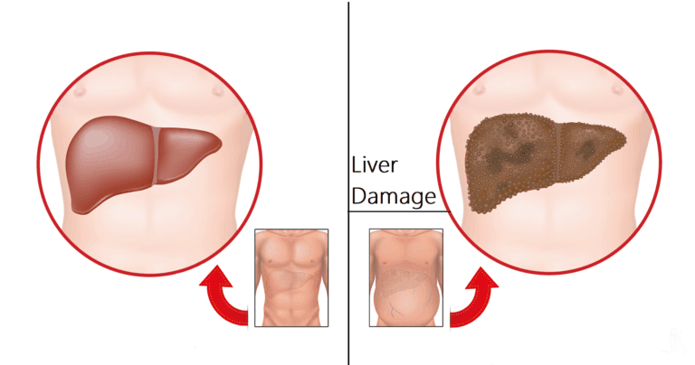 liver damage