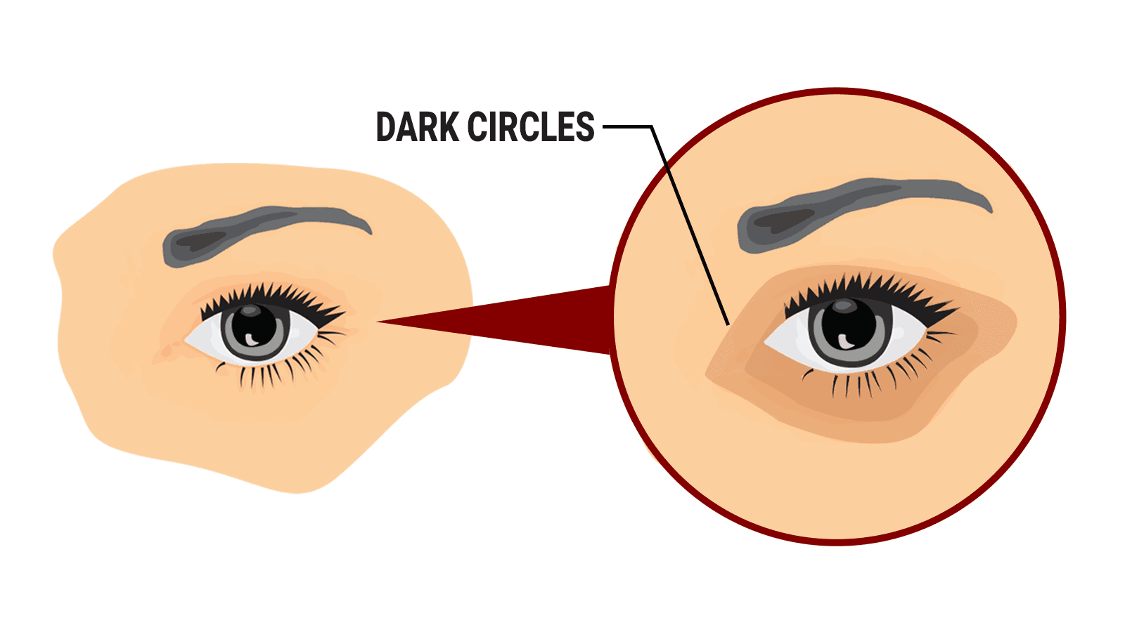 5 Easy Ways to Remove Dark Circles Under Eyes Naturally