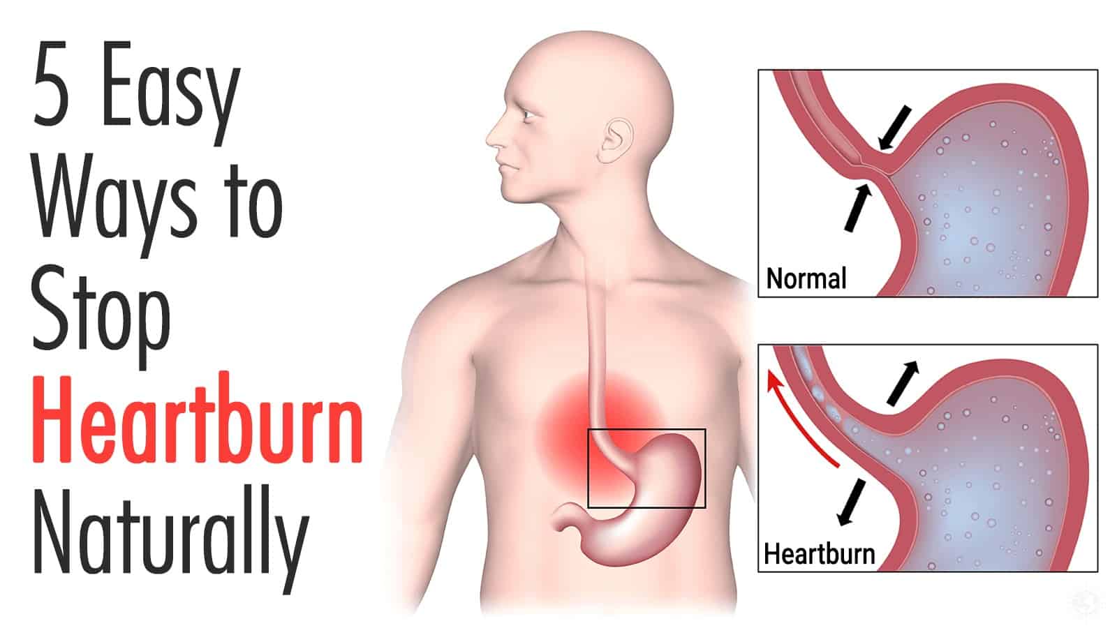 5 Easy Ways to Stop Heartburn Naturally