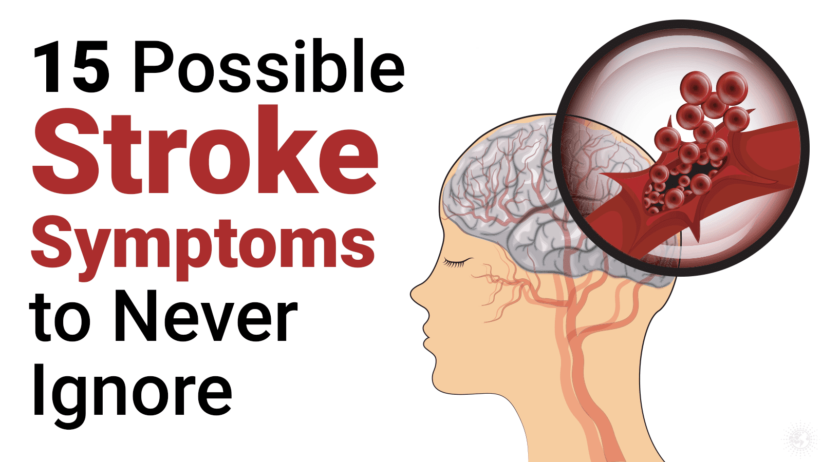 Prevent A Stroke: 15 Stroke Symptoms to Never Ignore
