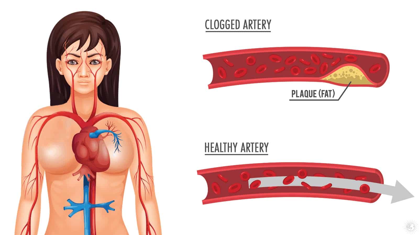 How to Flush Clogged Arteries Naturally with Just Three Ingredients