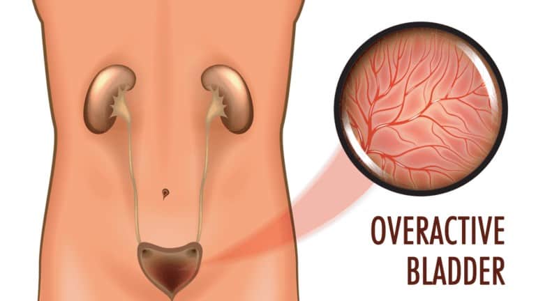 overactive bladder