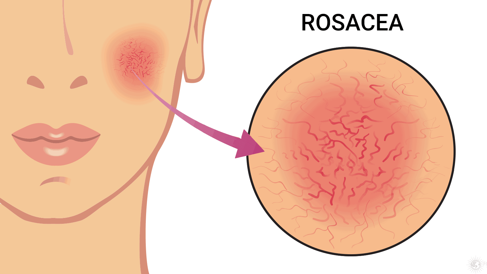 5 Early Warning Signs of Rosacea (and How to Treat It)